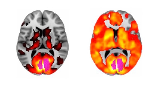 hersenscan lsd